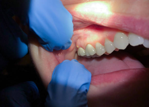 Best Lost Filling or Crown Replacement in Woods Cross, UT